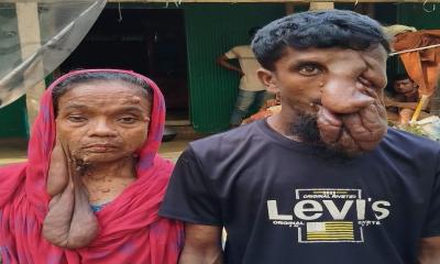 বিরল রোগে আক্রান্ত মা-ছেলে: চিকিৎসা আর সহানুভূতির অভাবে নিভে যাচ্ছে জীবনের আলো বিরল রোগে আক্রান্ত মা-ছেলে: চিকিৎসা আর সহানুভূতির অভাবে নিভে যাচ্ছে জীবনের আলো