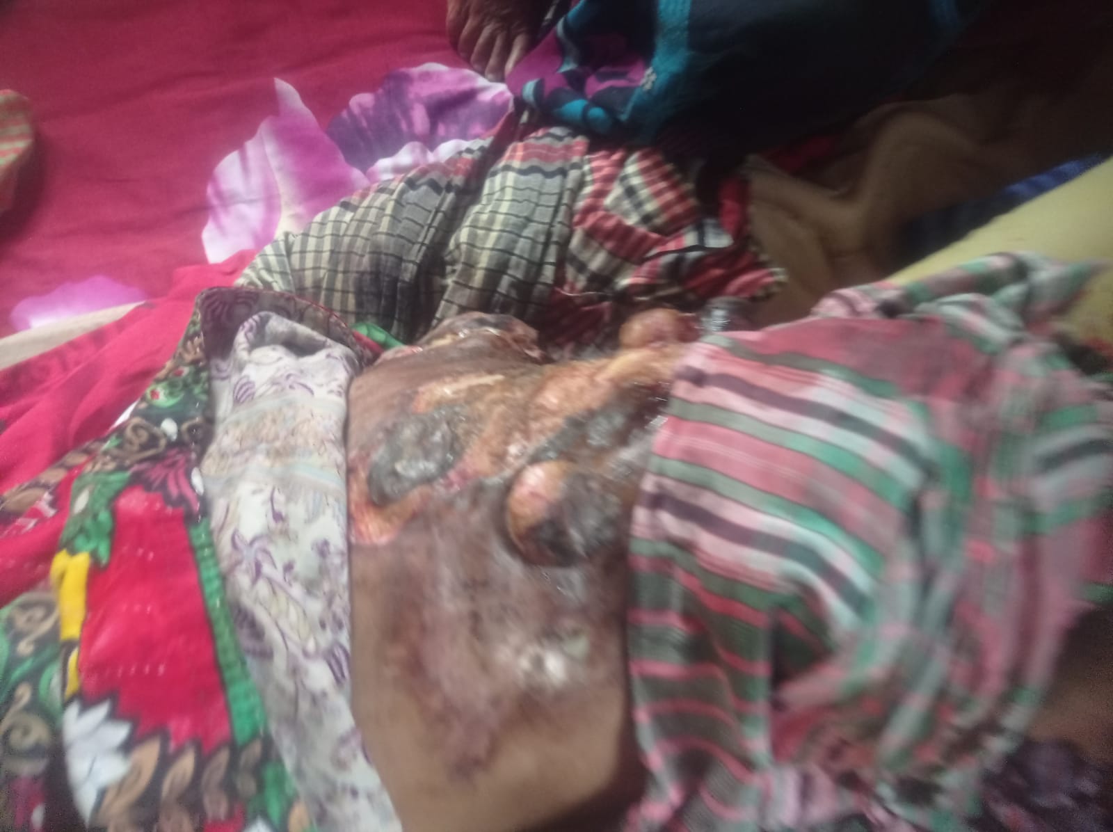 ক্যান্সার আক্রান্ত সুমনের বাঁচতে চান, সাহায্যের আকুতি পরিবারের!